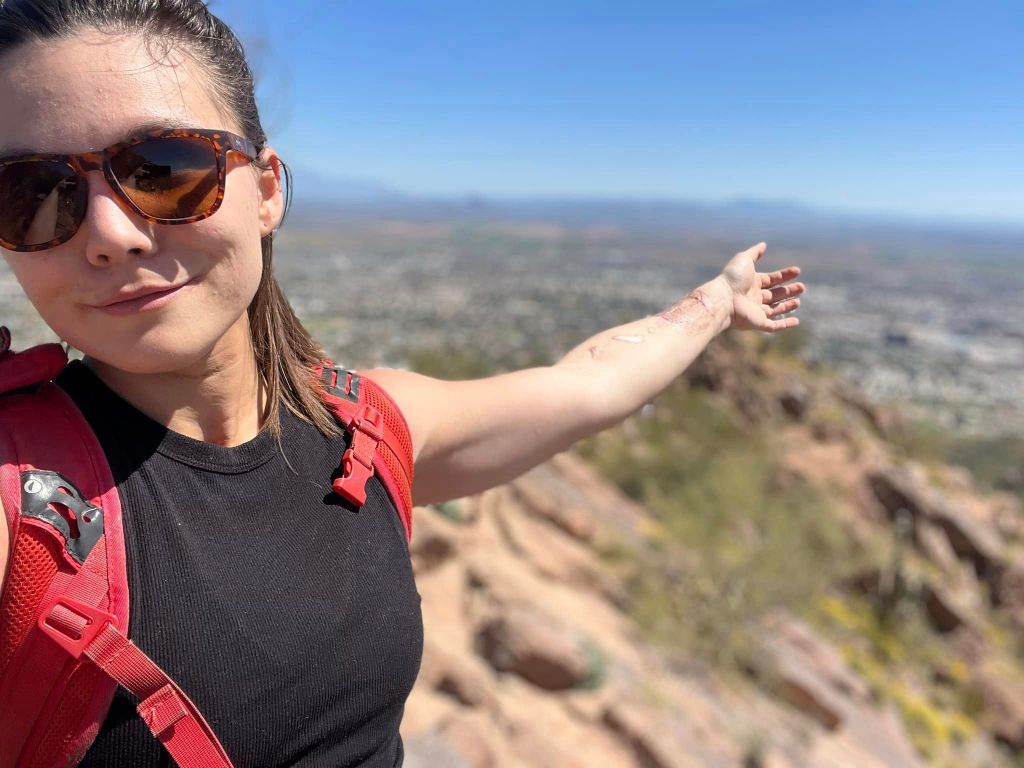 1-Year Post-Treatment